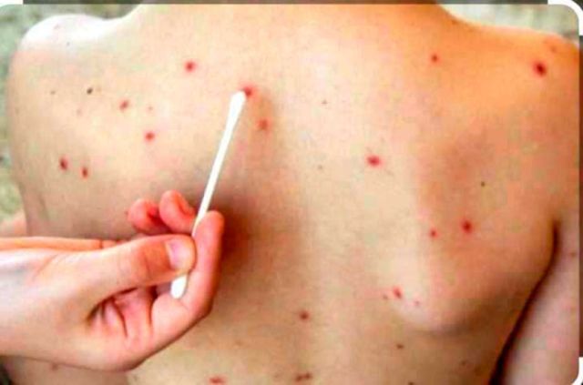 Aumento de casos de varicela genera preocupación en Potosí