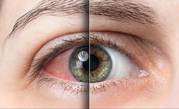 Identificando el síndrome del ojo seco: síntomas y cuidados necesarios